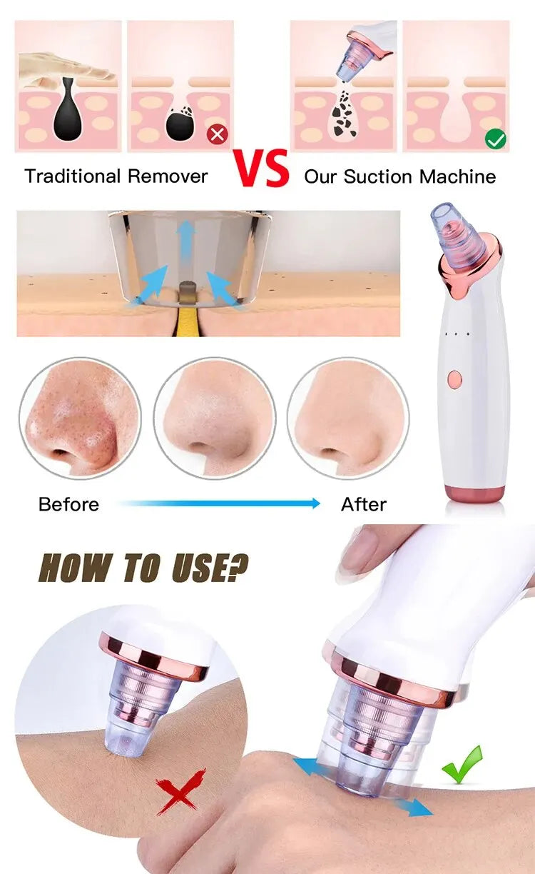 Instrumento de succión de espinillas que elimina las células muertas y las impurezas de la piel - Limpiador cosmético para espinillas y acné